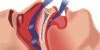 sleepapnoea.jpg