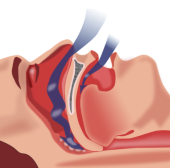 Myofunctional Therapy and Obstructive Sleep Apnoea