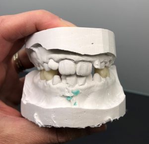 orofacial myofunctional therapy